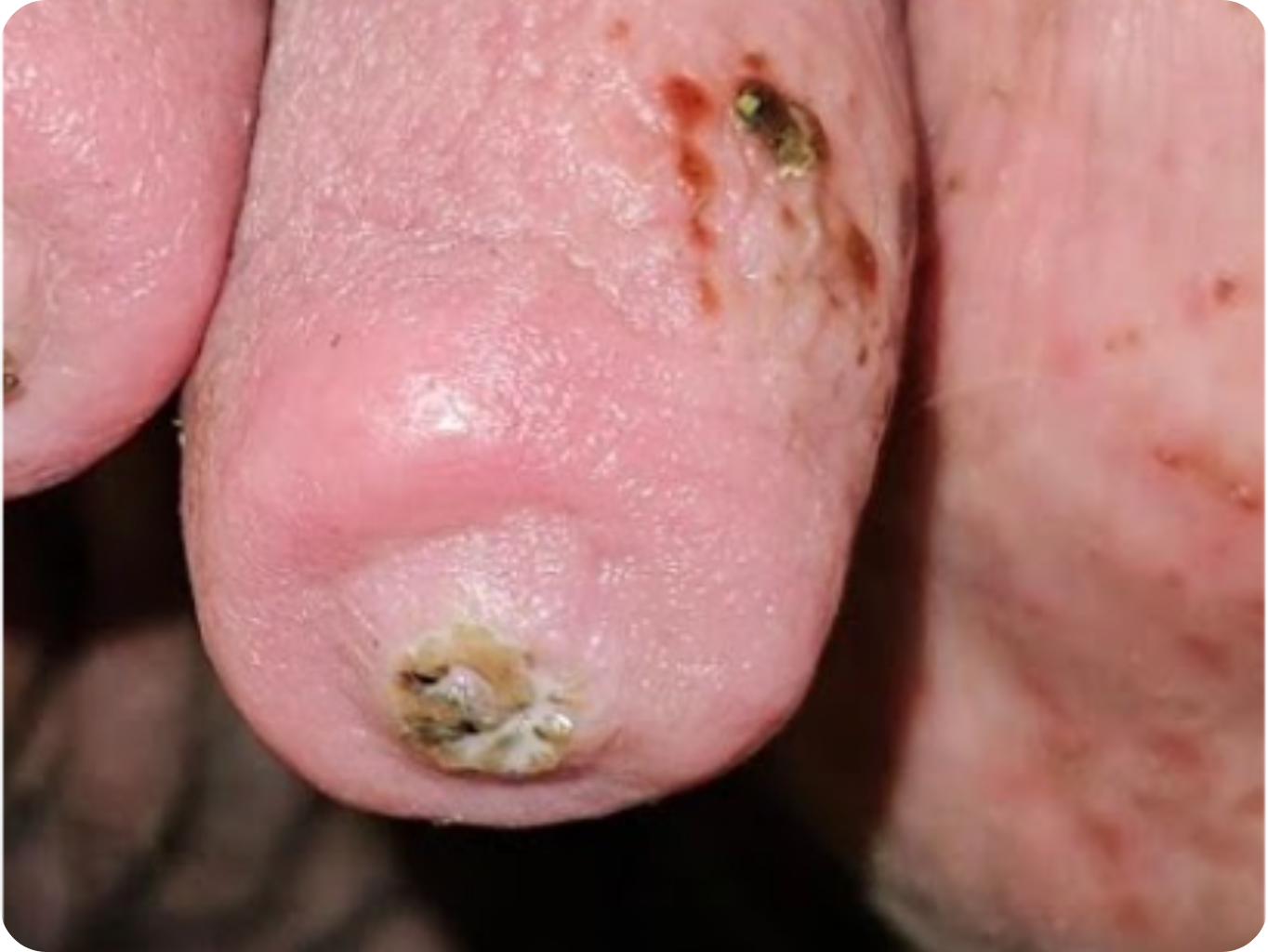 hyperkeratoza - 3. stupně